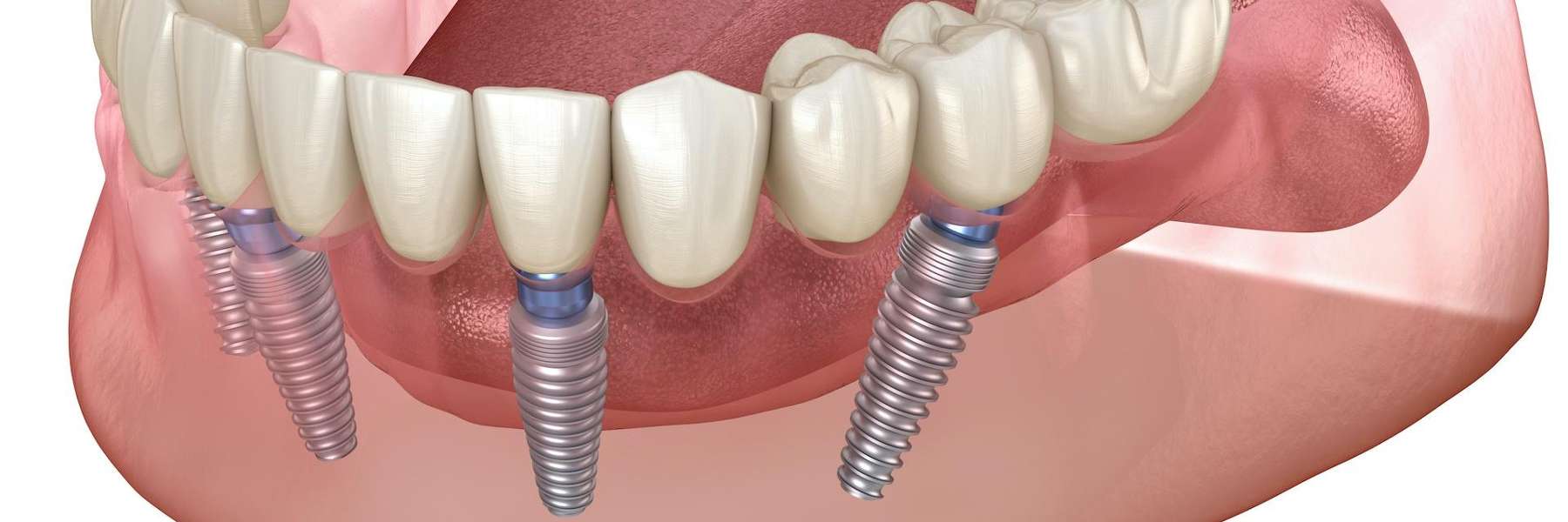 Dental Implants Illustration in Paducah, KY