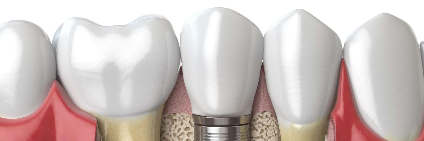 dental implants in paducah ky