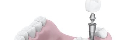 graphic of dental implant tooth