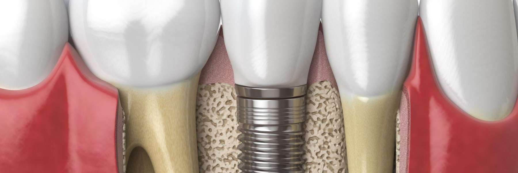 dental implant | Paducah KY