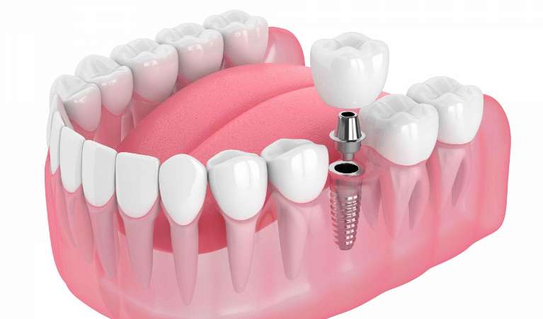 dental implant with screw illustration
