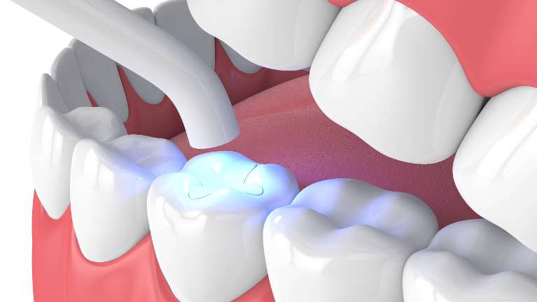 Tooth-Colored Fillings in Paducah, KY