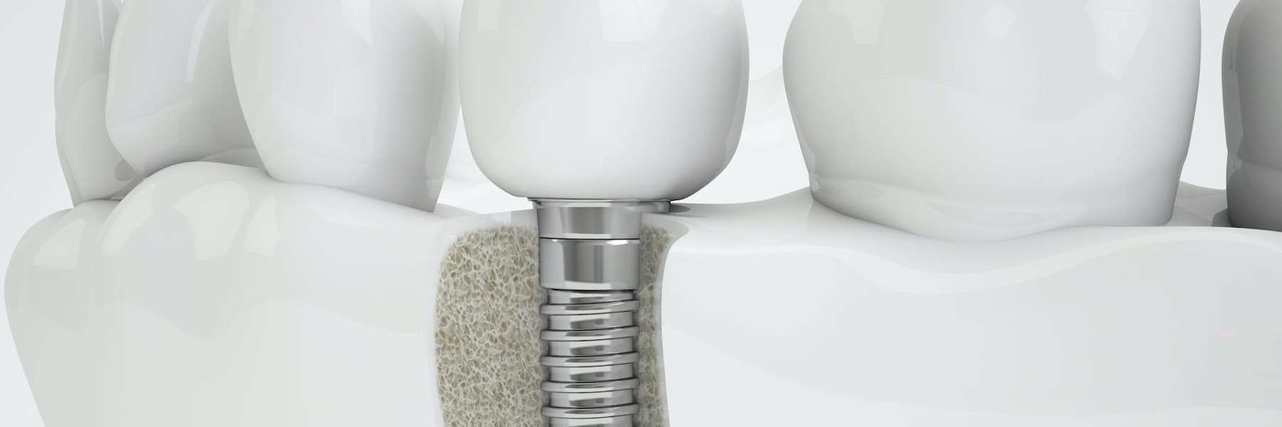 dental implant illustration